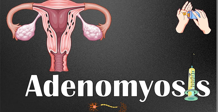 Adenomyosis
