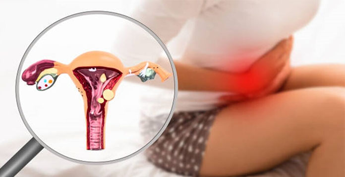 Endometriosis